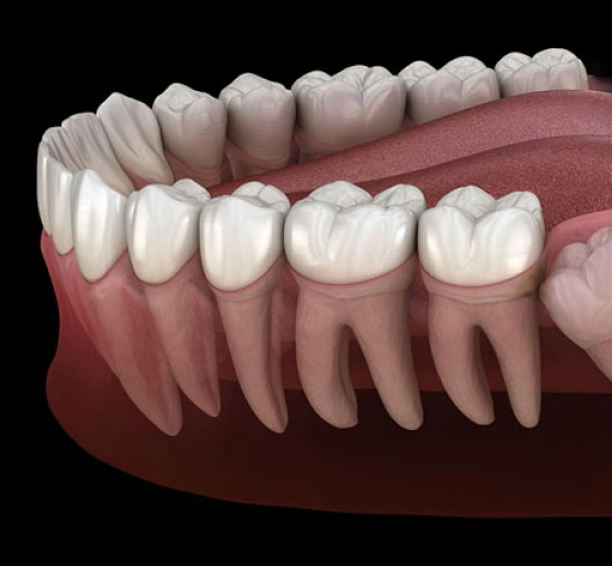 Wisdom Teeth Removal in Decatur, GA