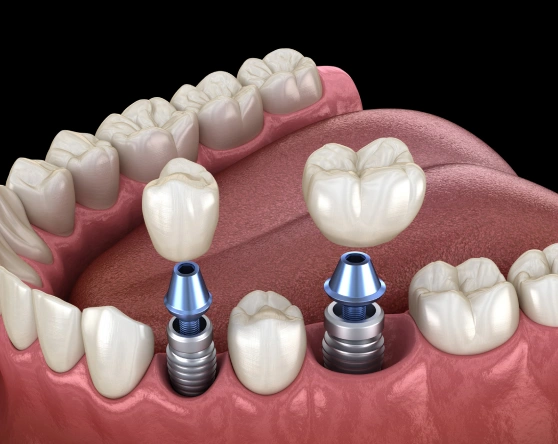 Druid Hills Dental provide dental implants in Decatur, GA