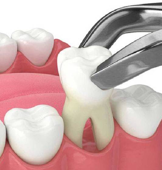 Druid Hills Dental provide tooth extractions in Decatur, GA